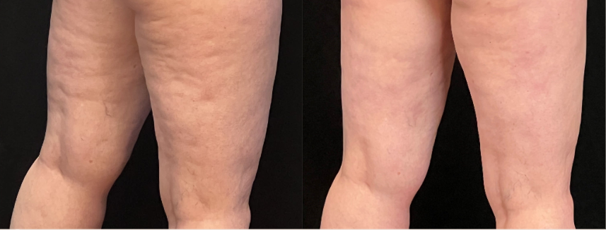 Banner Avéli™ Long-Term Cellulite Reduction Procedure