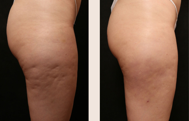 Banner Cellulite Treatment with Avéli