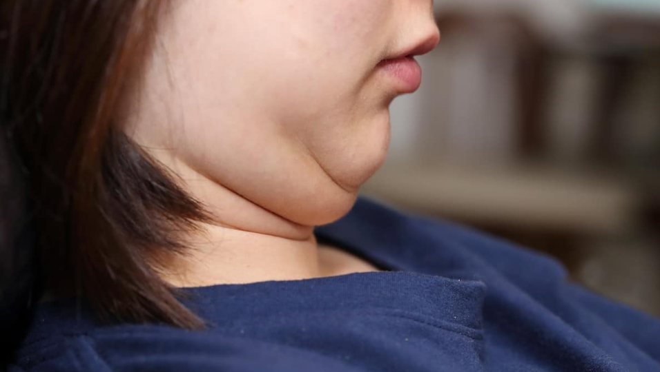 Banner Chin Up-  How Liposuction Can Finally Get Rid Of That Pesky Double Chin