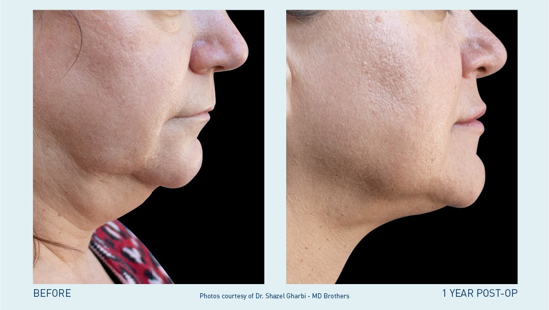 Banner Double Chin Liposuction: Weighing The Pros And Cons