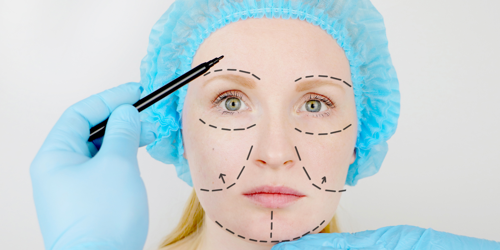 Banner Fat Grafting with Facelift: Achieving Natural Volume Without the Overfilled Look