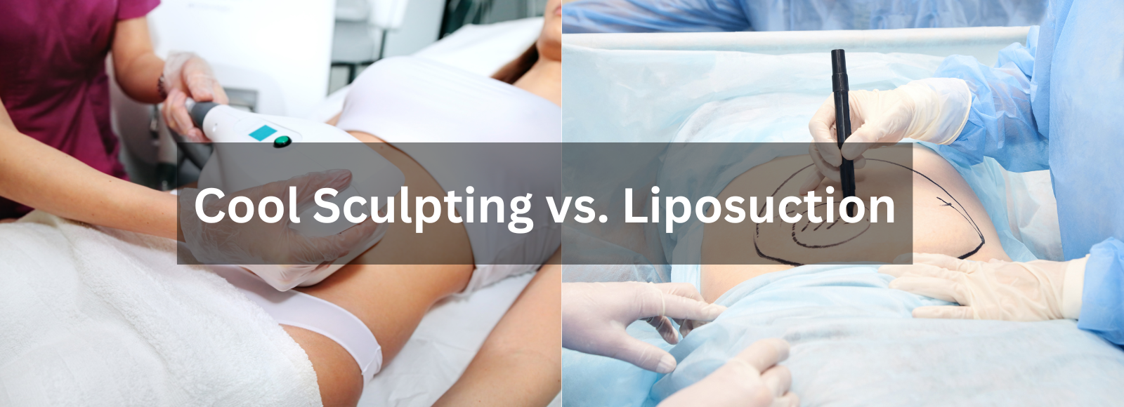 Banner Fat Removal Showdown: Cool Sculpting vs. Liposuction