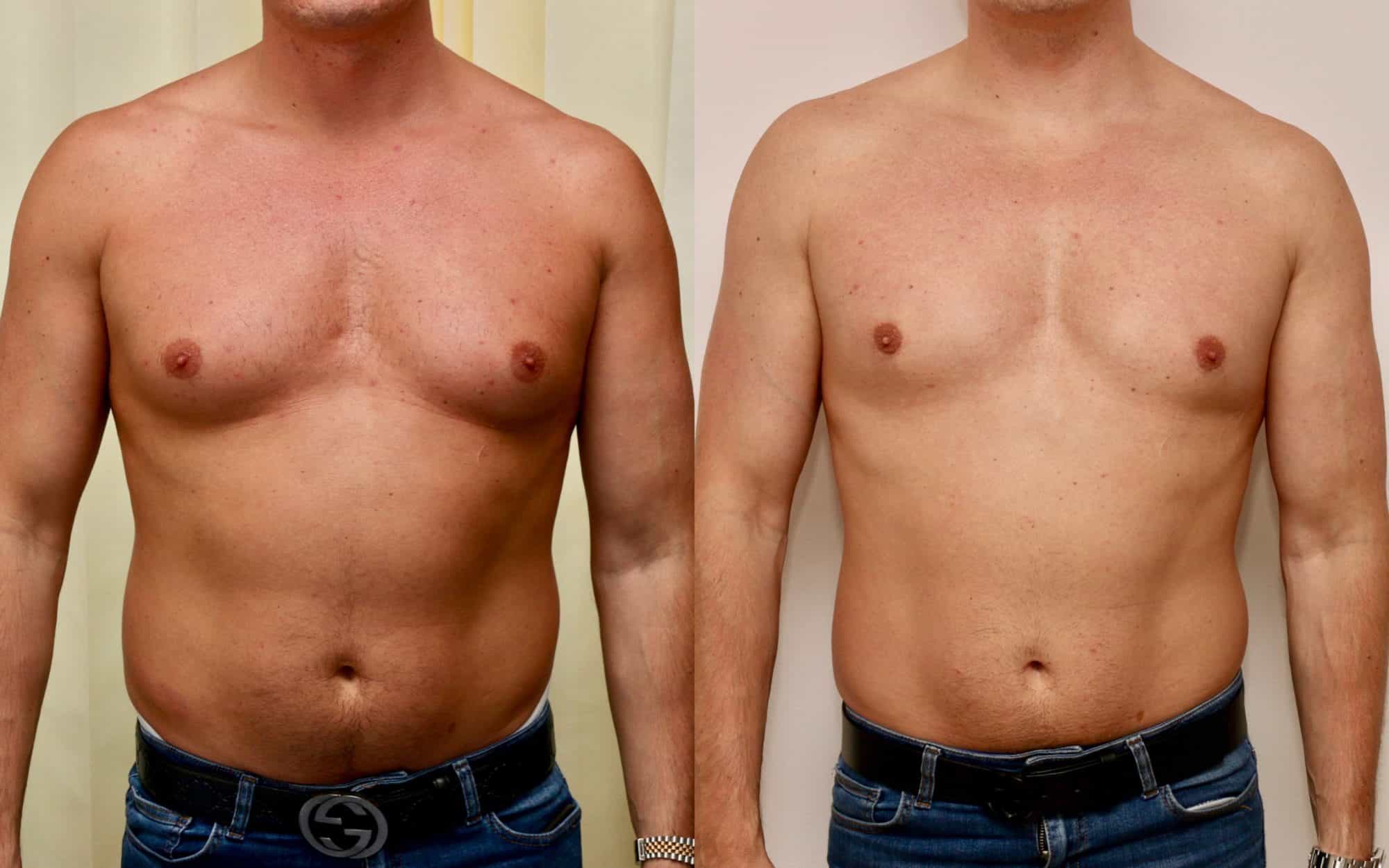 Banner How To Address Extra Skin Following Gynecomastia Treatment