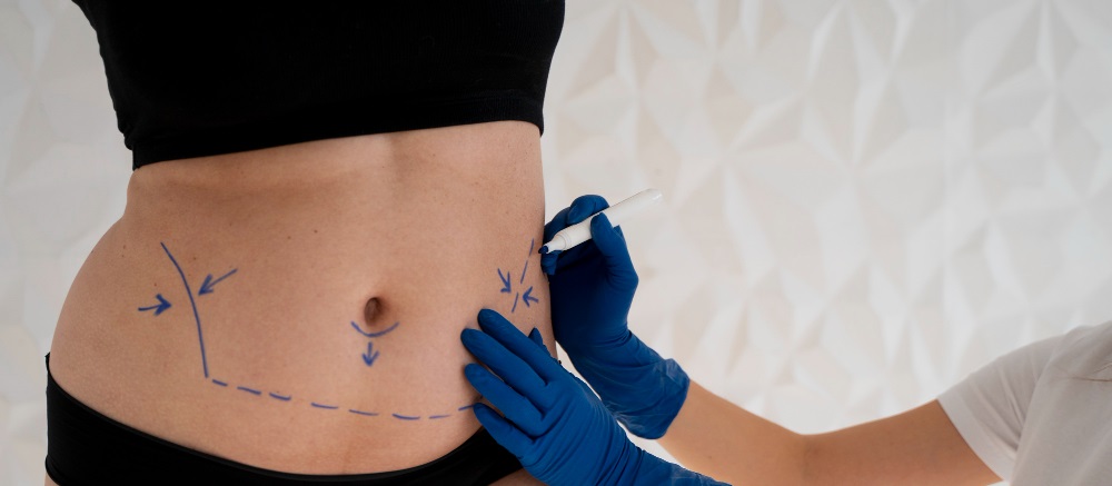 Banner Is Liposuction Fat Transfer Right For You?