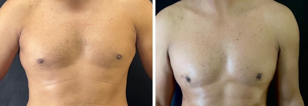 Banner Male Breast Reduction Surgery: Let’s Talk About Scars