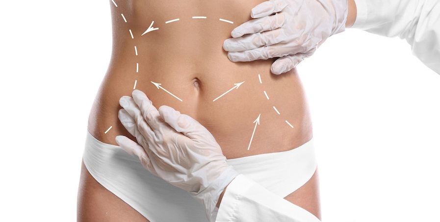Banner Removing Excess Skin: Liposuction Or Body Lift?