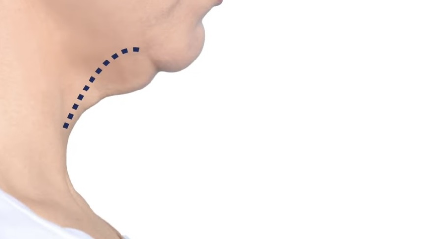 Banner Tightening Neck Skin Through Liposuction