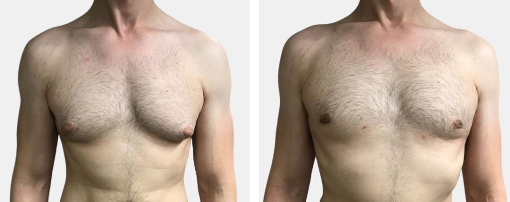 Banner Understanding Gynecomastia: Causes, Symptoms, and Treatment Options