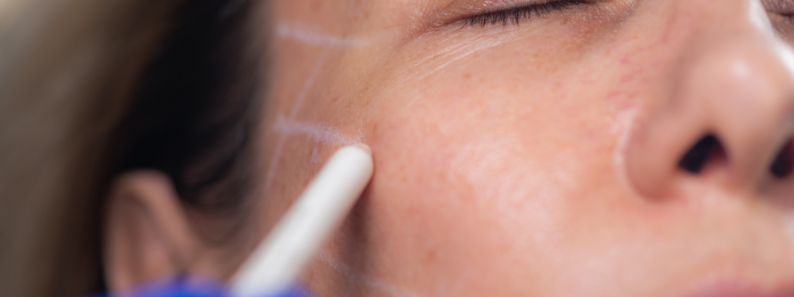 Before, During, and After Facelift Surgery: What You Need to Know