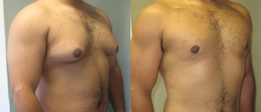Early Signs Of Gynecomastia