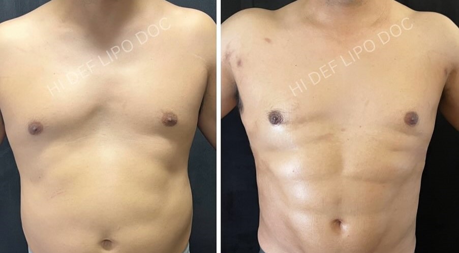Gynecomastia vs. Chest Fat: Understanding the Key Differences