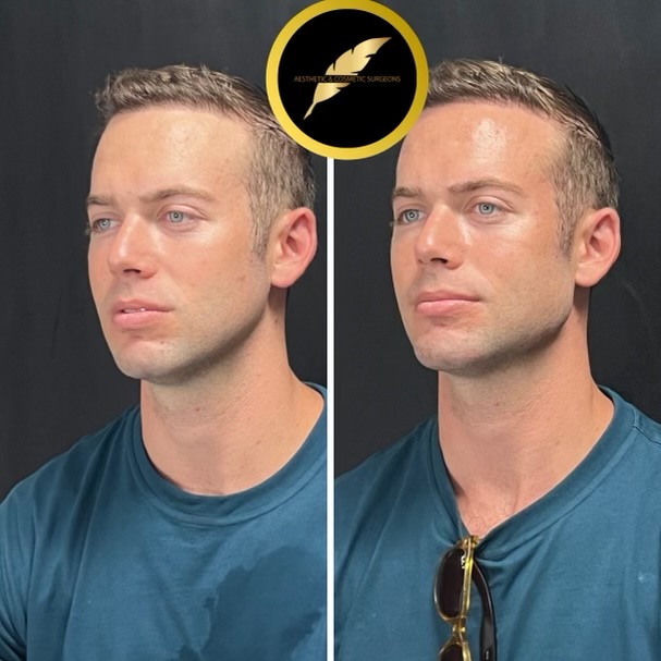 Hairline Aware Facelifts and Neck Lifts for Men: Incision Planning, Hair Density and Natural Results