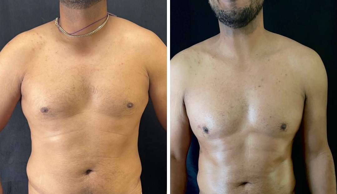 thumbnill Male Breast Reduction Surgery: Let’s Talk About Scars