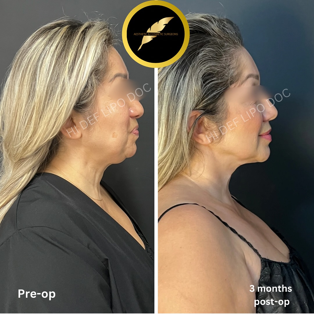 Chin Liposuction Neck Skin Tightening in Los Angeles: Before & After Result Photos