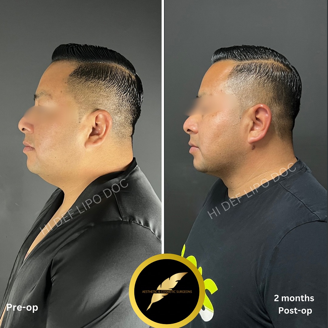 Chin Liposuction Neck Skin Tightening in Los Angeles: Before & After Result Photos