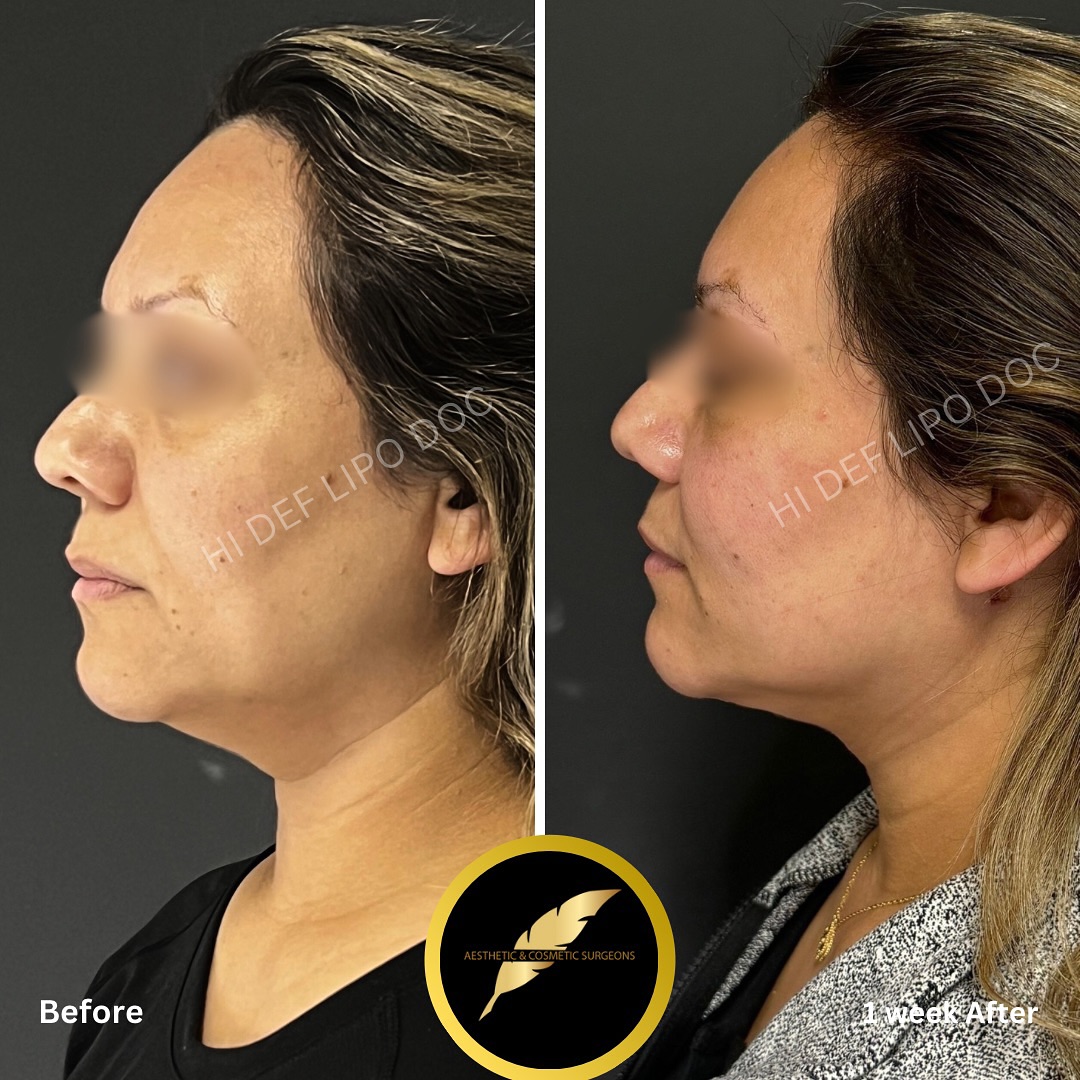 Chin Liposuction Neck Skin Tightening in Los Angeles: Before & After Result Photos