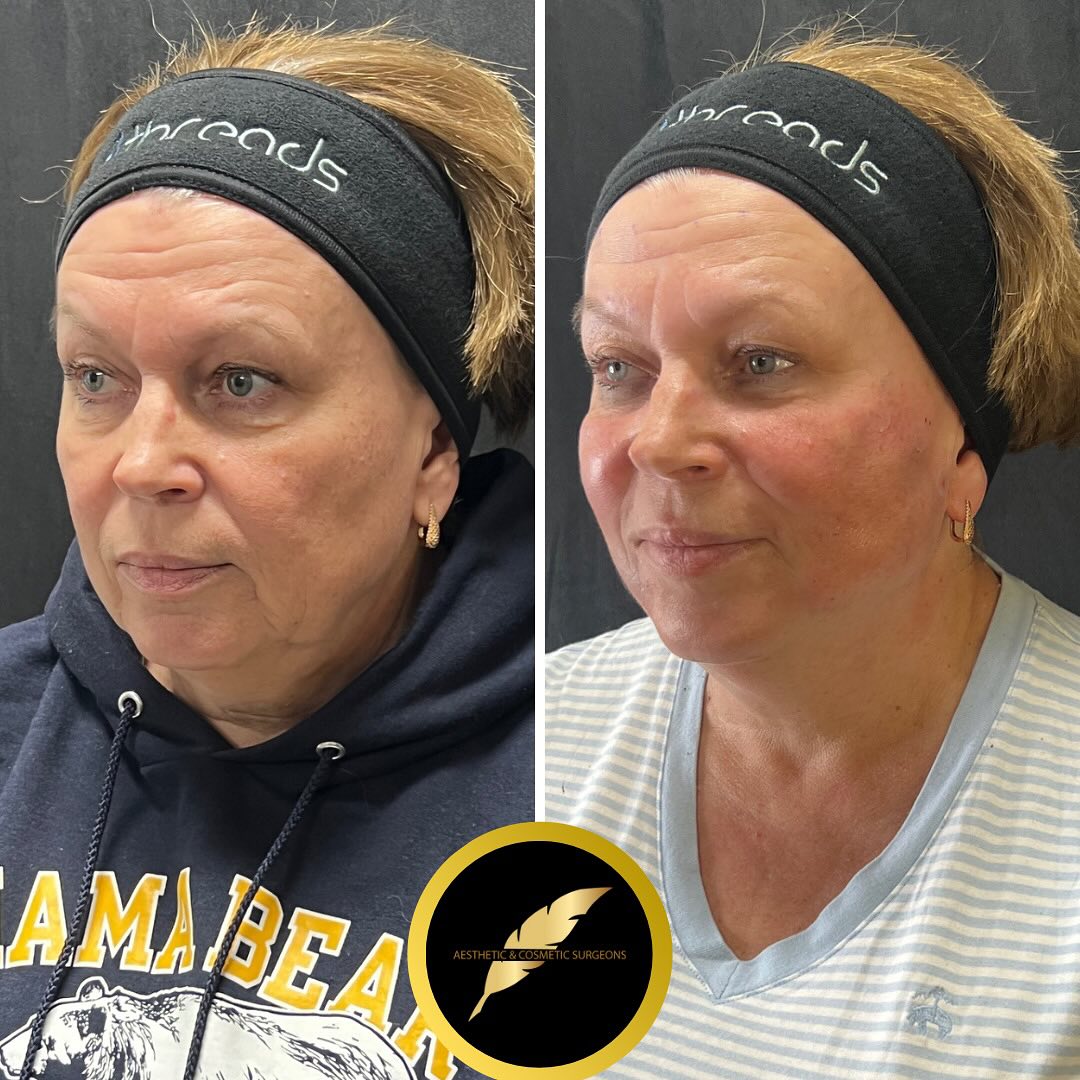 PDO Thread Lift in Los Angeles