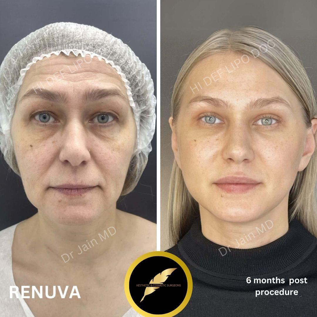 Facelift Treatment in Los Angeles: Before & After Result Photos