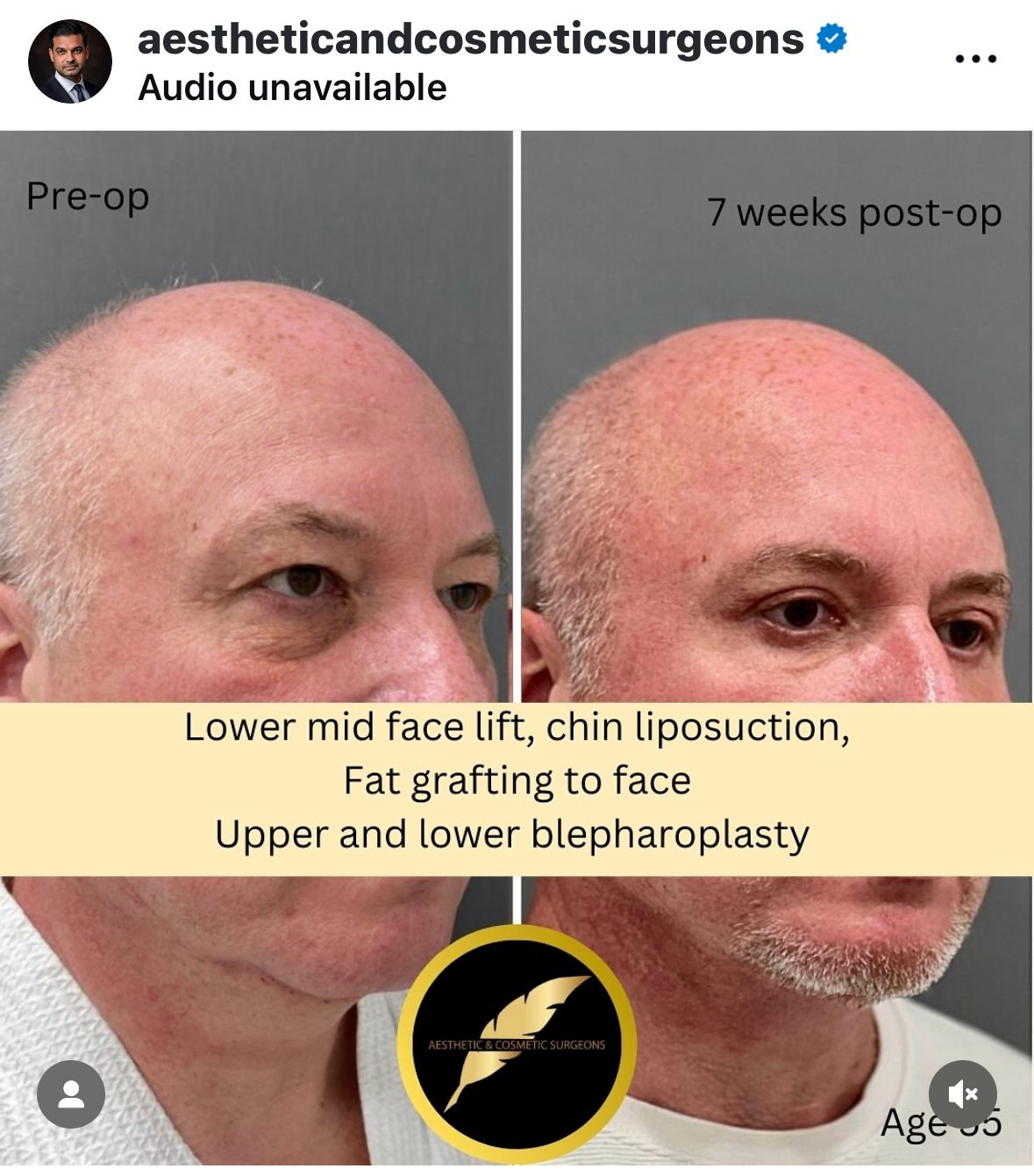 Facelift Treatment in Los Angeles: Before & After Result Photos