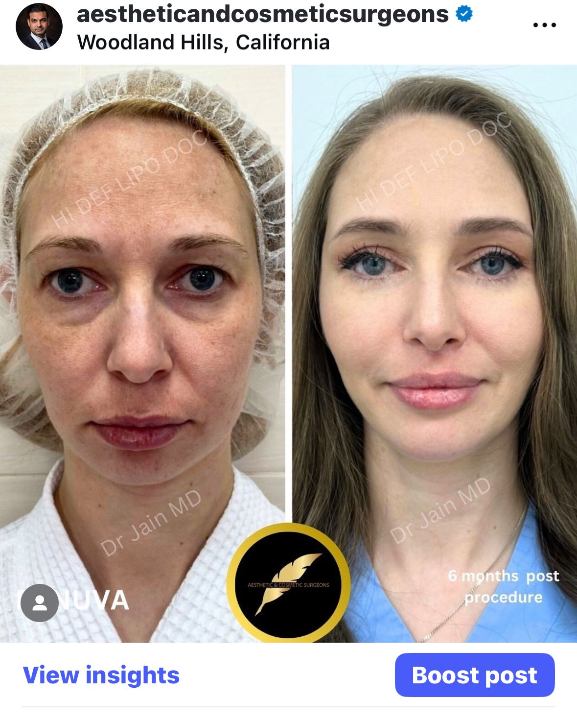 Fat Transfer to Face in Los Angeles: Before & After Result Photos