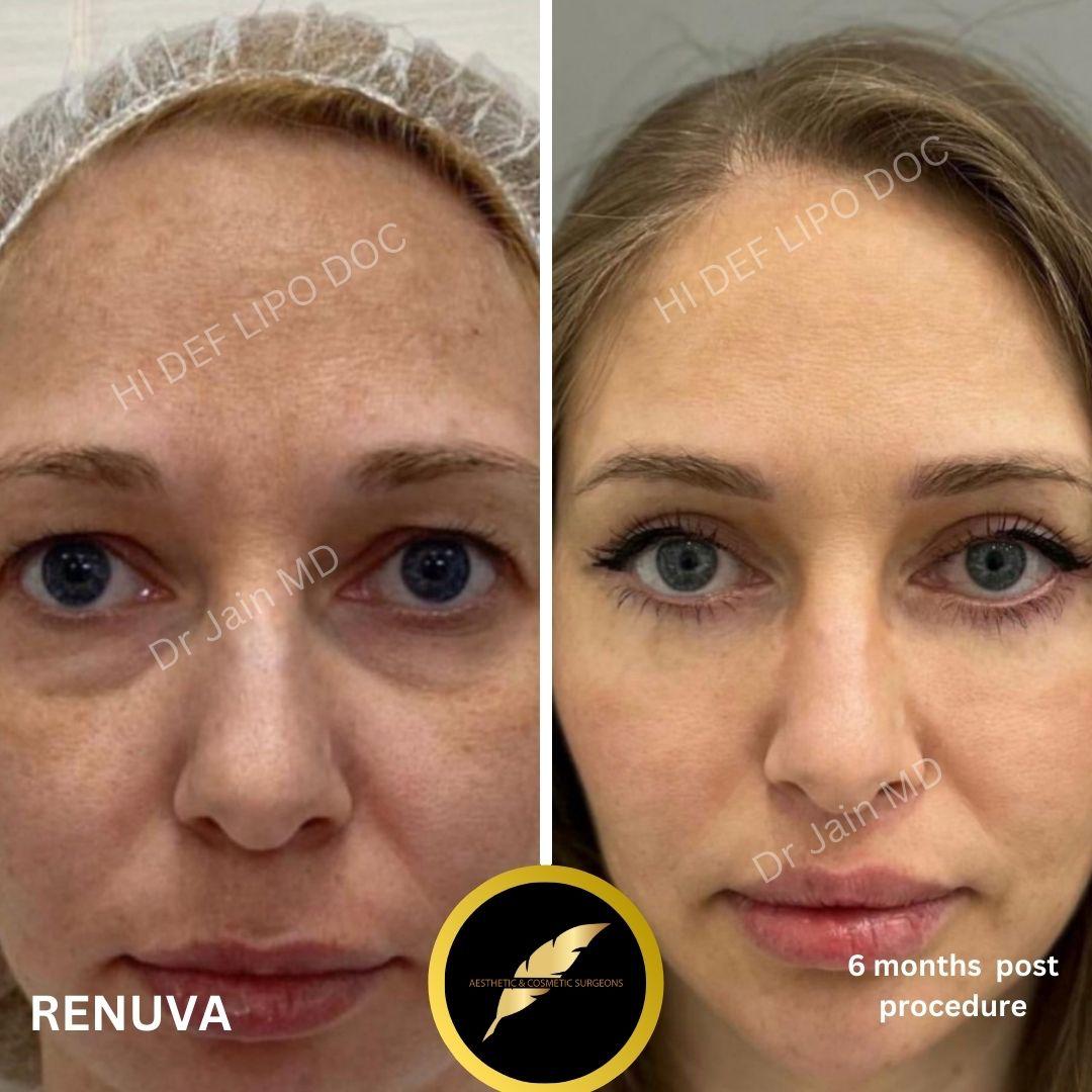 Neck Lift Treatment in Los Angeles: Before & After Result Photos