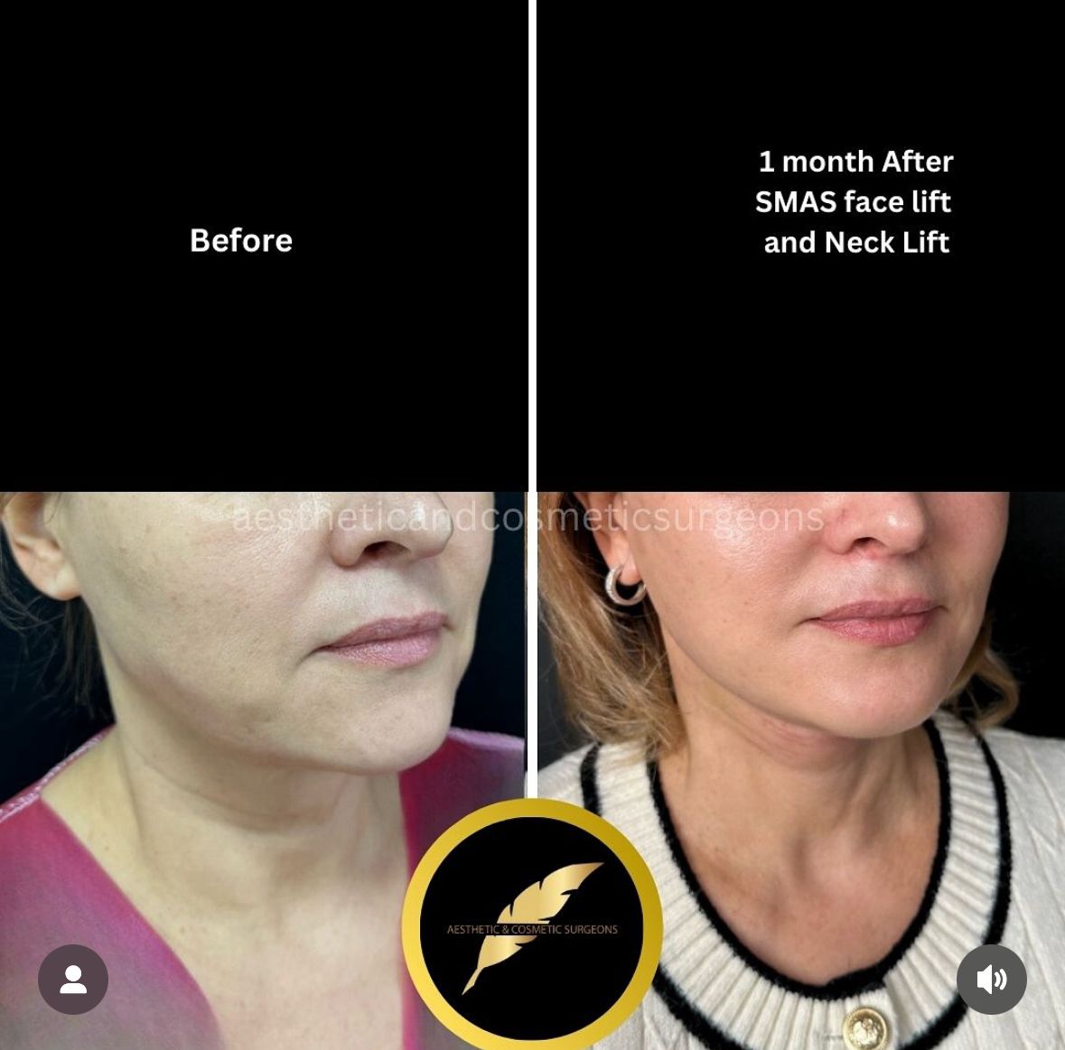 Neck Lift Treatment in Los Angeles: Before & After Result Photos