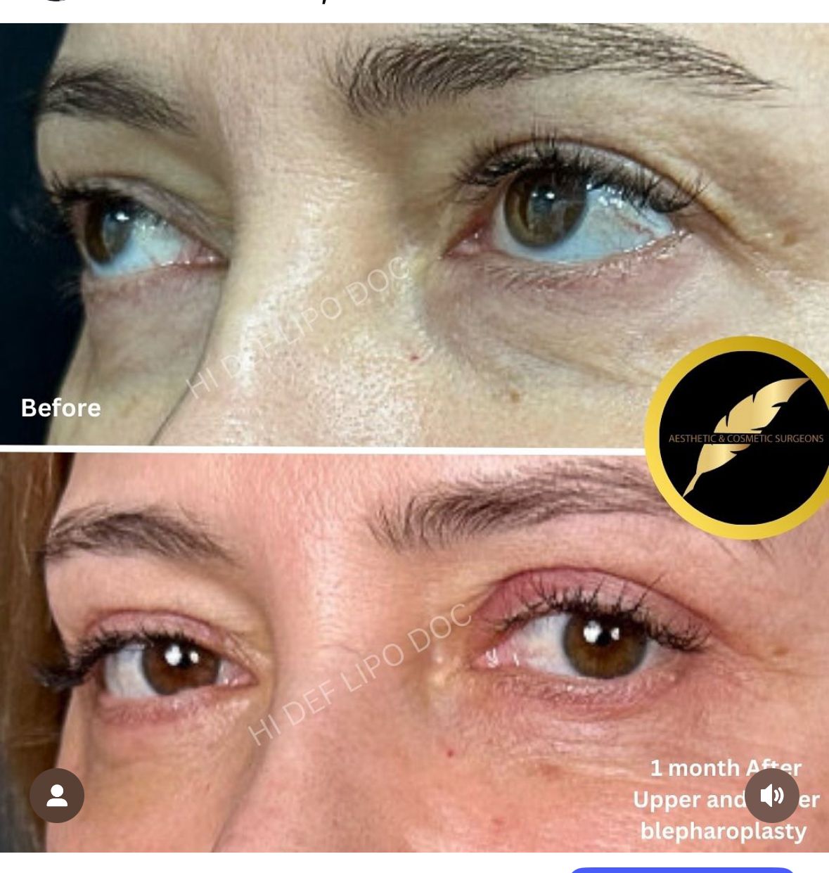 Eyelid Surgery in Los Angeles: Before & After Result Photos