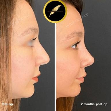 Rhinoplasty in Los Angeles