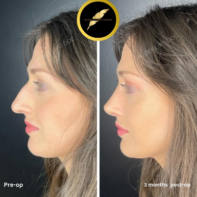 Rhinoplasty in Los Angeles