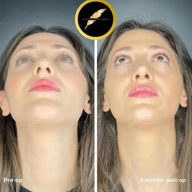 Rhinoplasty in Los Angeles