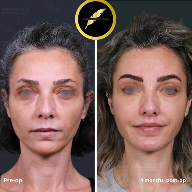 Browlift Treatment in Los Angeles: Before & After Result Photos
