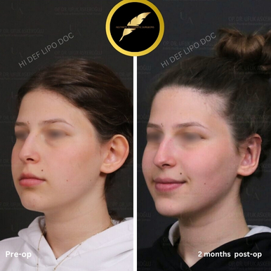 Otoplasty Treatment in Los Angeles: Before & After Result Photos