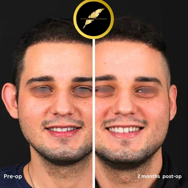 Otoplasty Treatment in Los Angeles: Before & After Result Photos