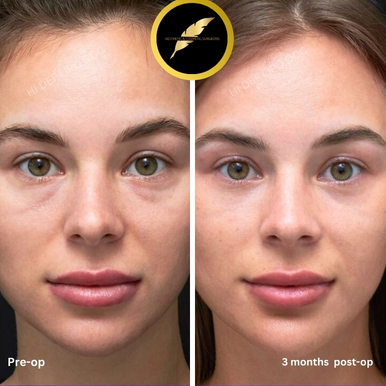 Eyelid Surgery in Los Angeles: Before & After Result Photos