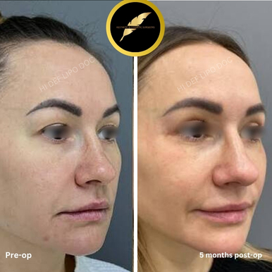 Eyelid Surgery in Los Angeles: Before & After Result Photos