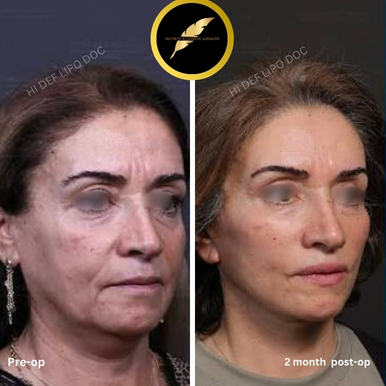 Facelift Treatment in Los Angeles: Before & After Result Photos