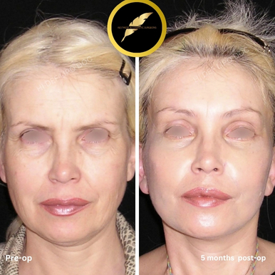 Facelift Treatment in Los Angeles: Before & After Result Photos