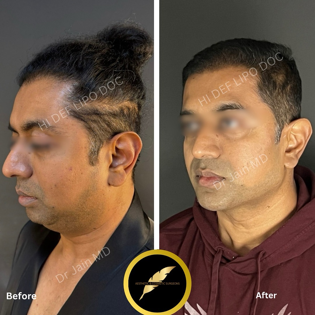 Chin Liposuction Neck Skin Tightening in Los Angeles: Before & After Result Photos