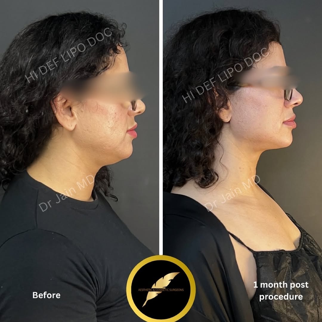 Chin Liposuction Neck Skin Tightening in Los Angeles: Before & After Result Photos