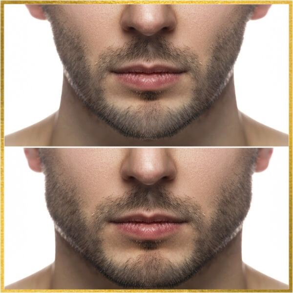 Jawline Chin contouring for Men
