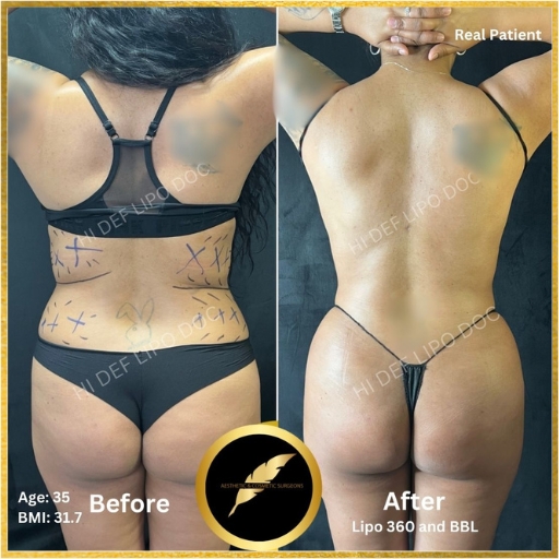 Refining Your Silhouette With Fat Transfer To The Butt