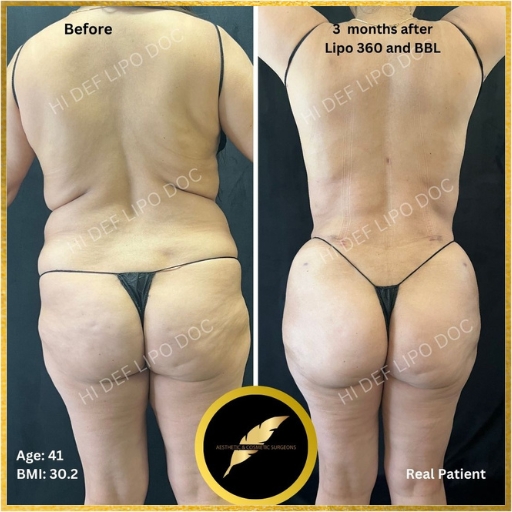 What to Expect from a Fat Transfer to Butts: Sculpting Your Dream Curves