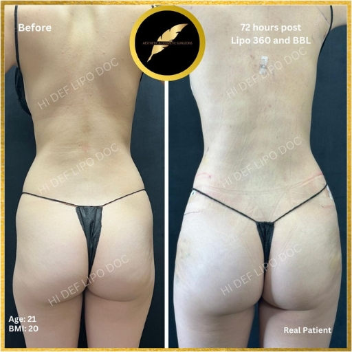 Achieve Your Dream Curves With Fat Transfer to the Buttocks, Glutes or Hip Dips