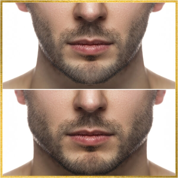 Jawline and Chin Contouring In Newport Beach