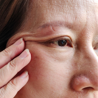 Lower Eyelid Surgery