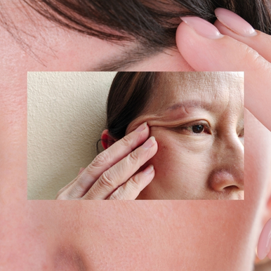 What to Expect From Eyelid Surgery