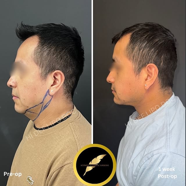 Chin Liposuction And Neck Contouring by Dr. Jain 