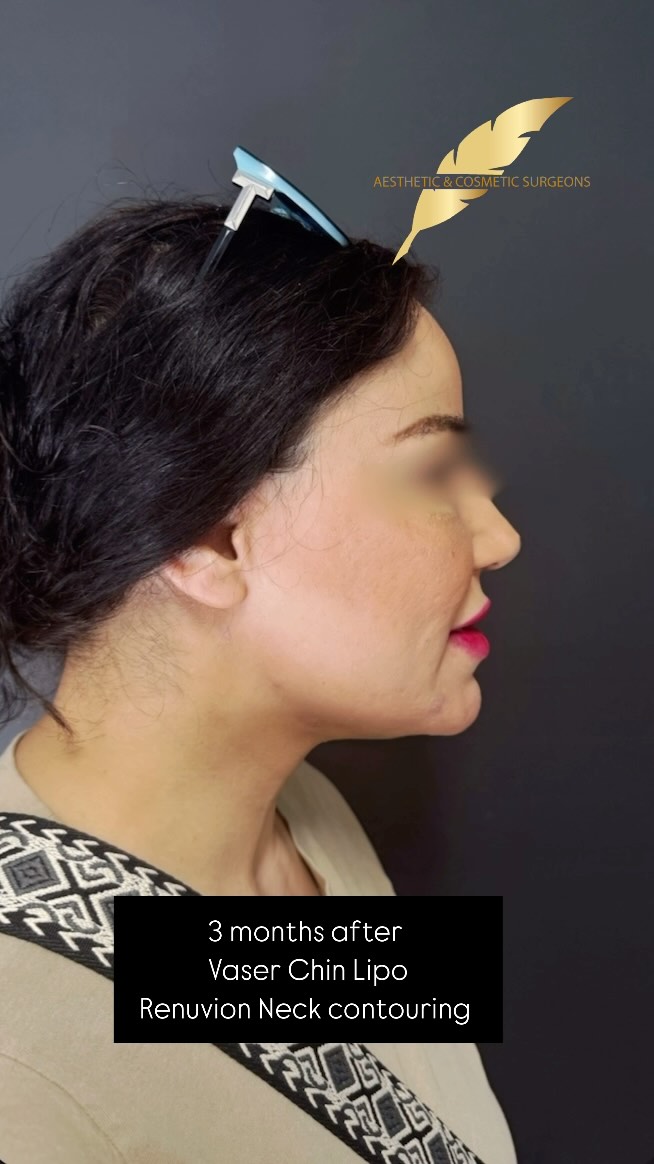 Chin Liposuction And Neck Contouring by Dr. Jain 